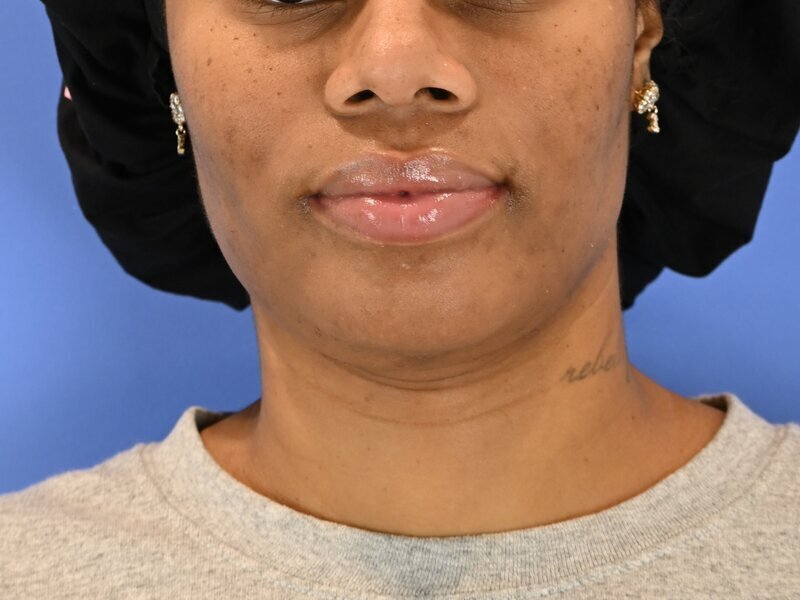 Chin Reduction Before & After Image