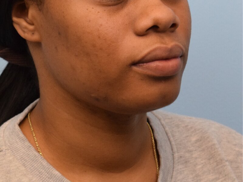 Chin Reduction Before & After Image