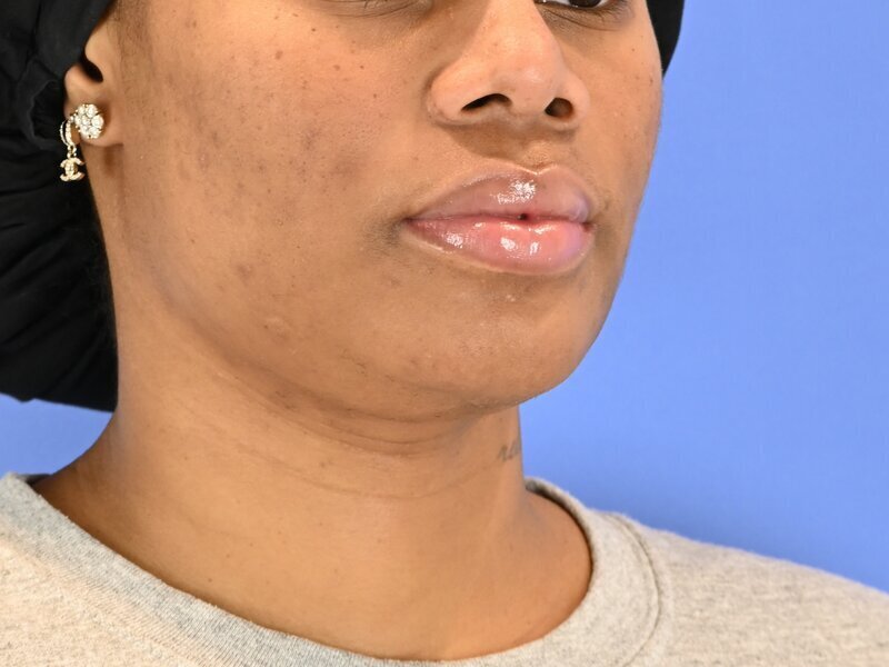 Chin Reduction Before & After Image