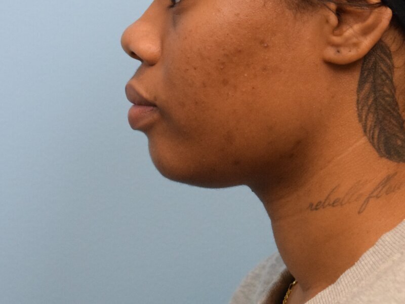 Chin Reduction Before & After Image