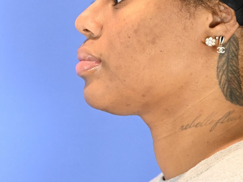 Chin Reduction Before & After Image