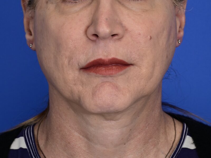 Chin Reduction Before & After Image