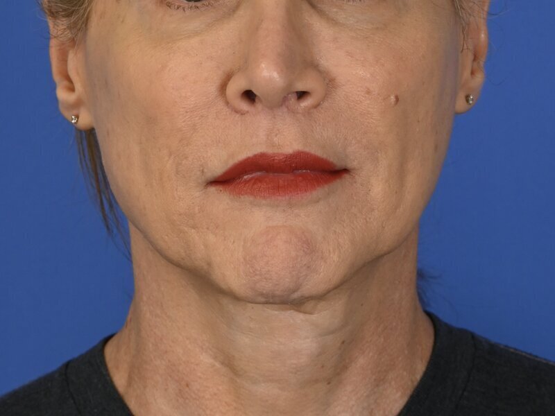 Chin Reduction Before & After Image