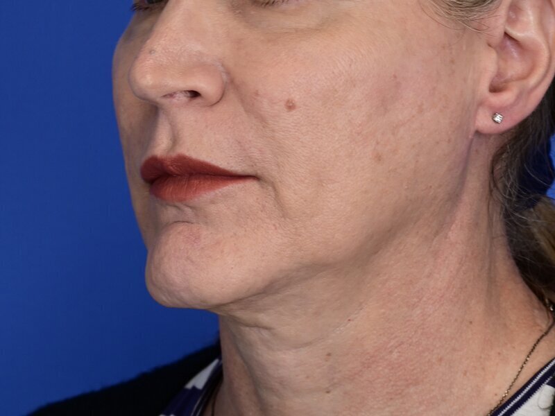 Chin Reduction Before & After Image