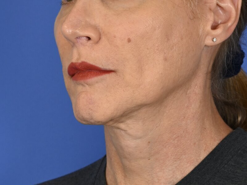 Chin Reduction Before & After Image