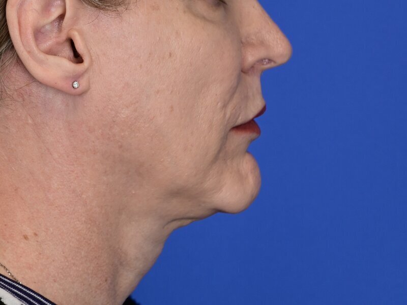 Chin Reduction Before & After Image