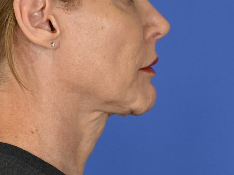 Chin Reduction Before & After Image