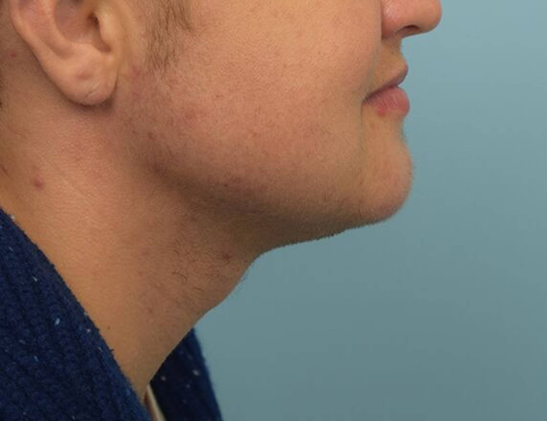 Jaw Implants Before & After Image