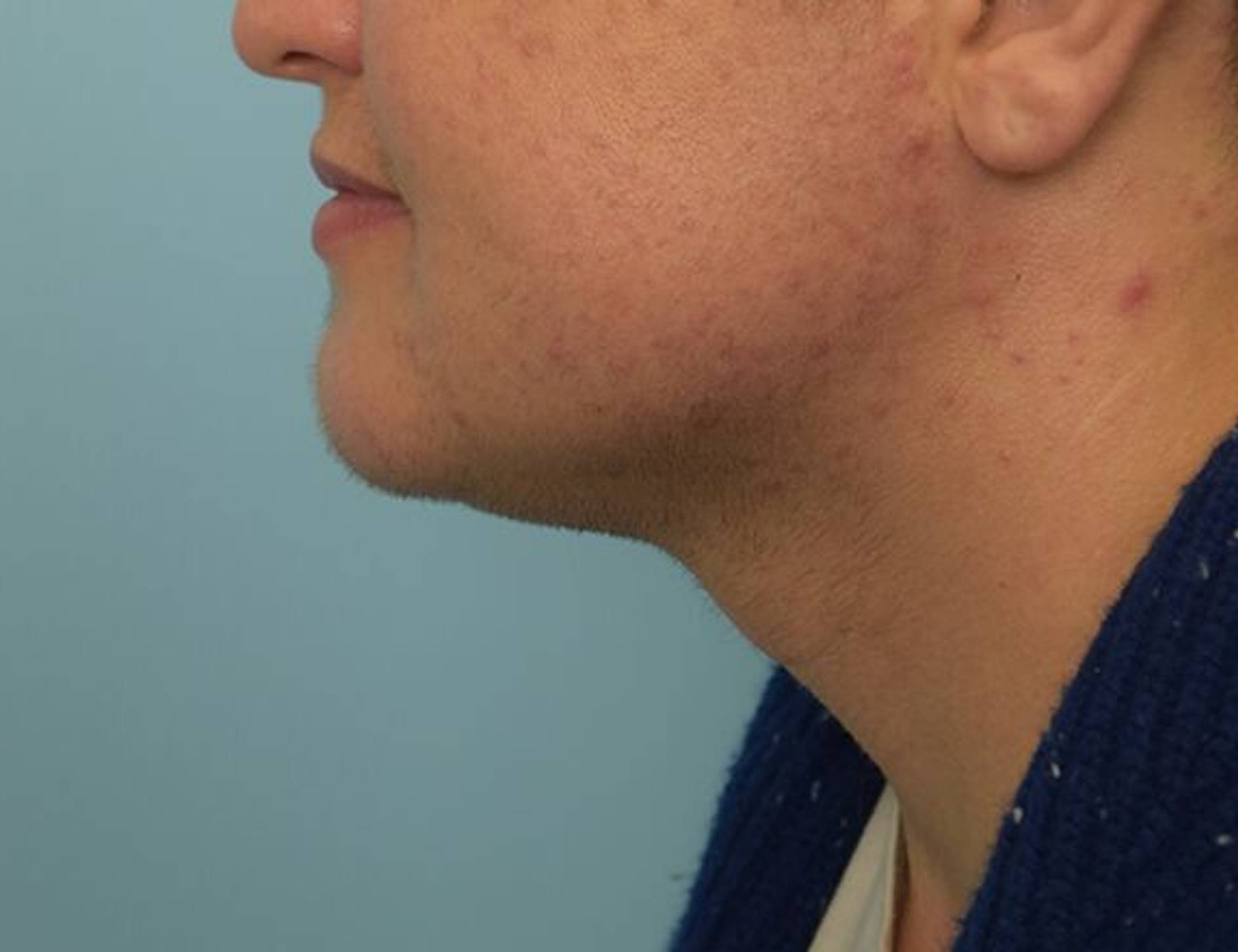 Jaw Implants Before & After Image