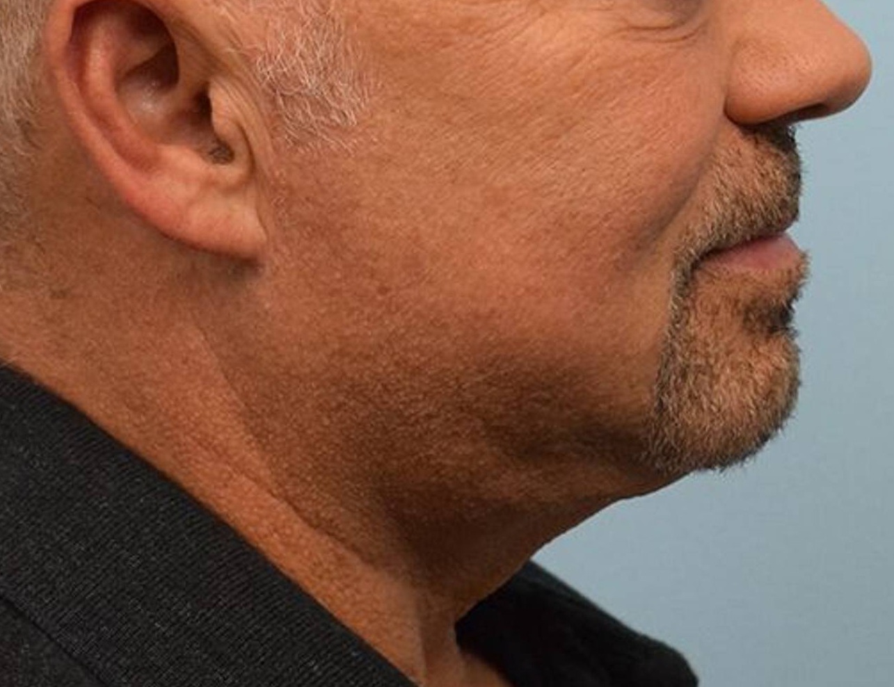 Jaw Implants Before & After Image