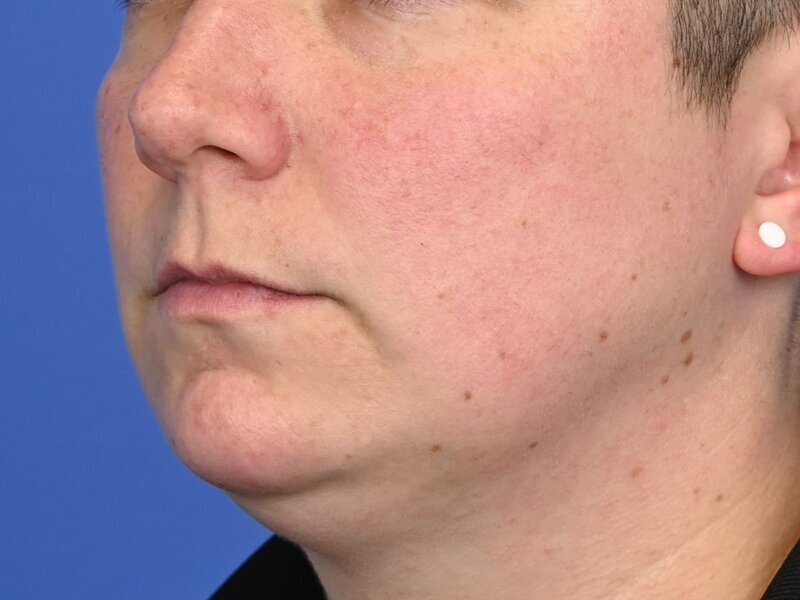 Jaw Implants Before & After Image