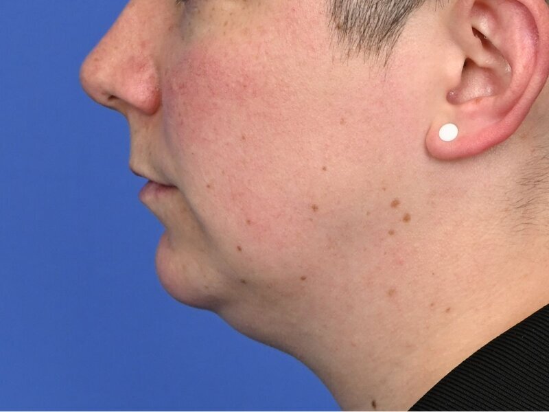 Jaw Implants Before & After Image