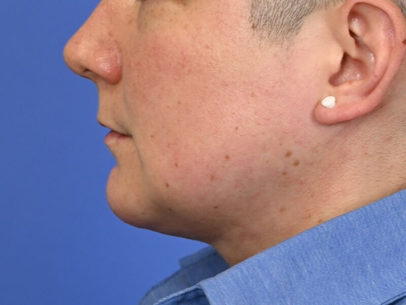 Jaw Implants Before & After Image