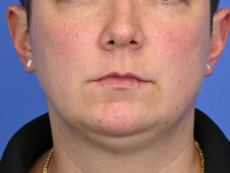 Jaw Implants Before & After Image