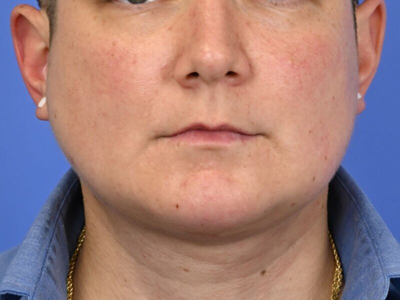 Jaw Implants Before & After Image