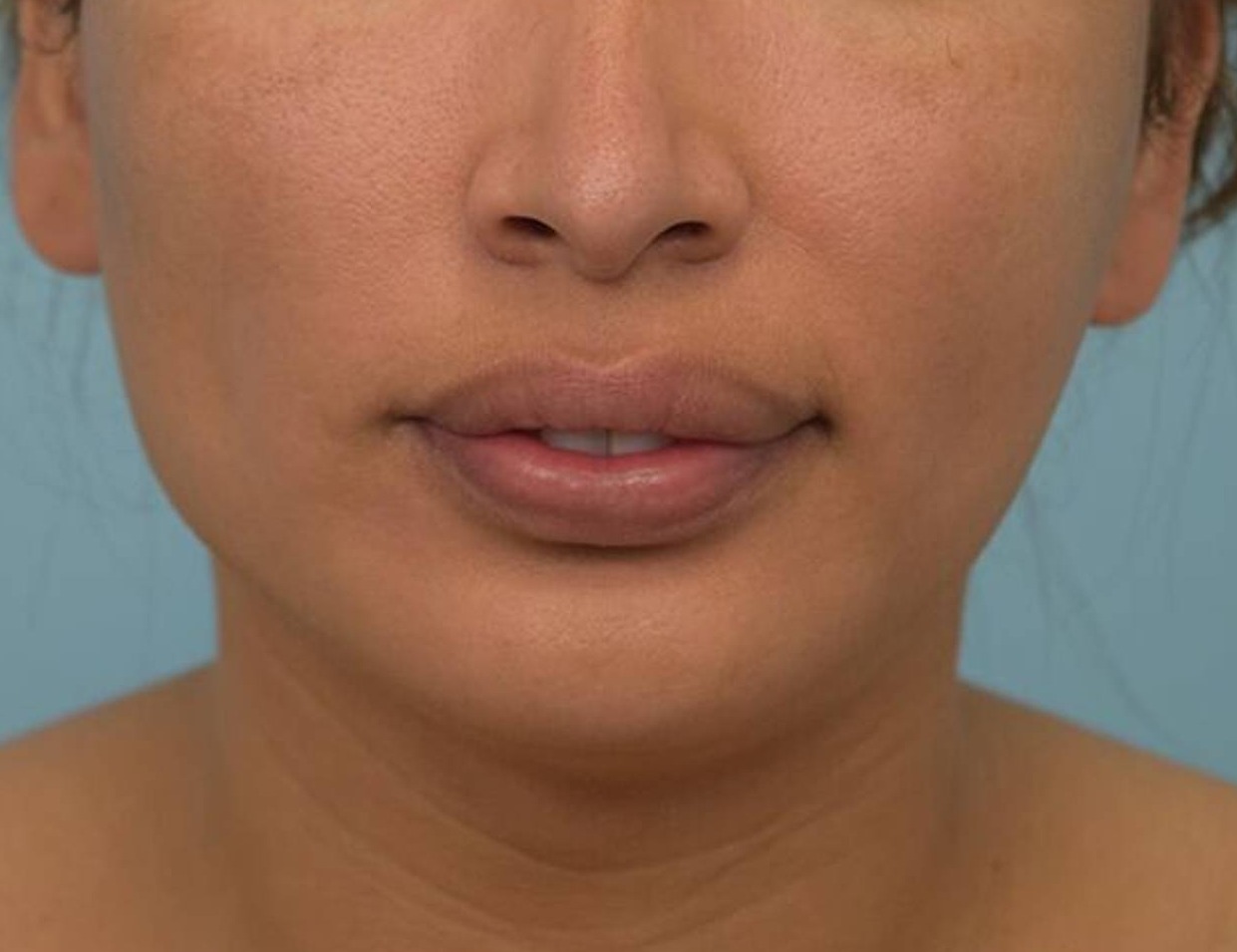 Osseous Genioplasty Before & After Image