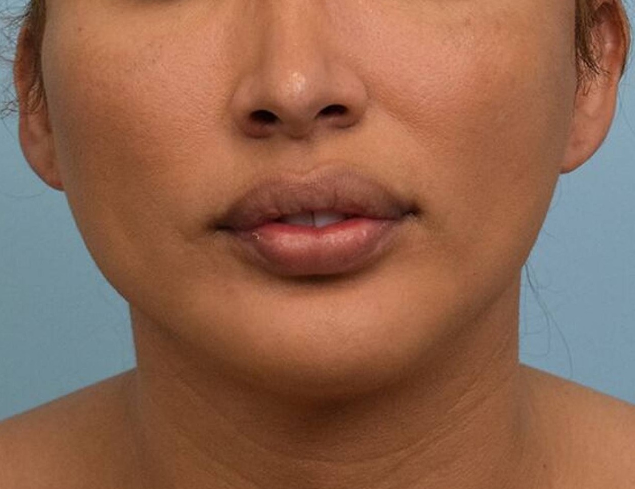 Osseous Genioplasty Before & After Image