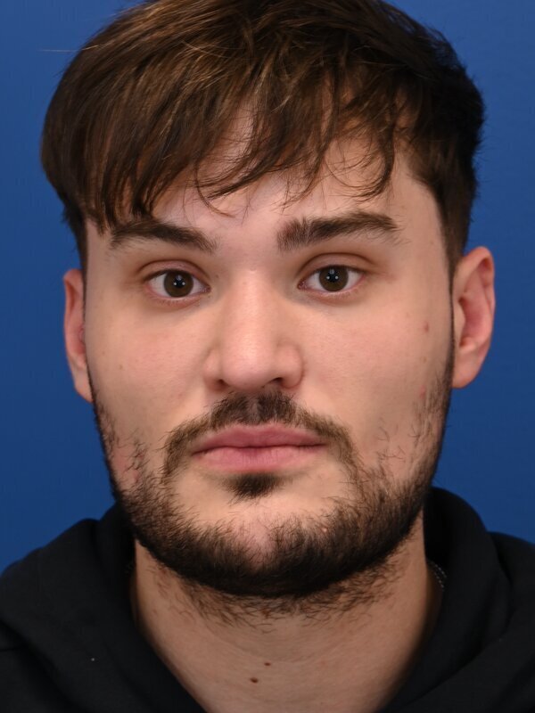 V Line Surgery  Before & After Image