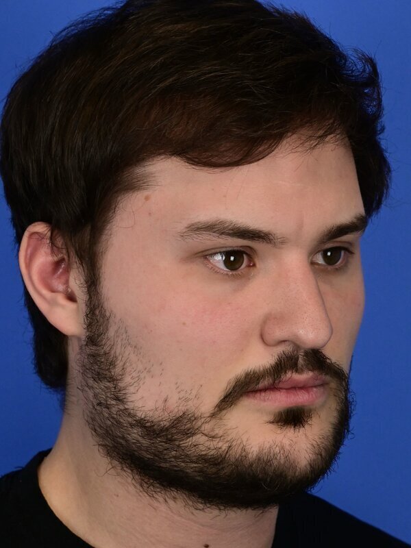 V Line Surgery  Before & After Image