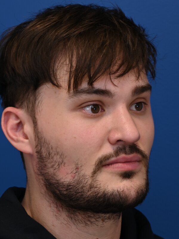 V Line Surgery  Before & After Image