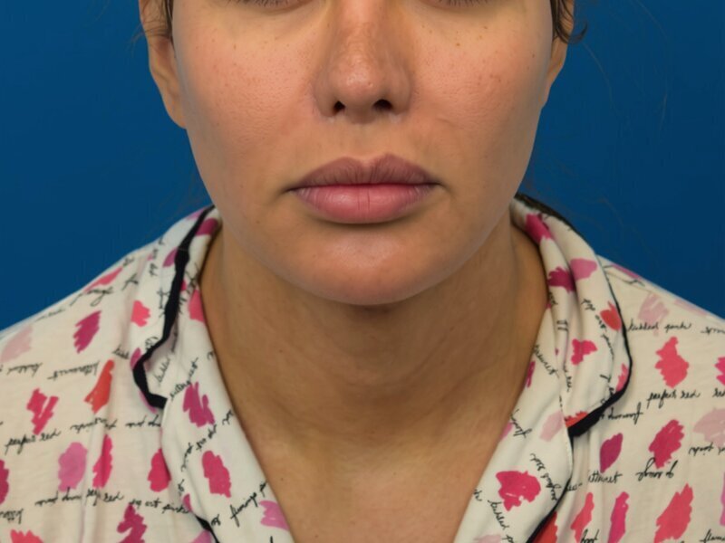 V Line Surgery  Before & After Image