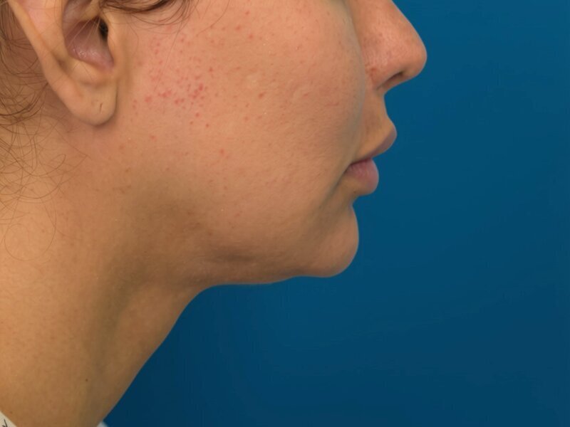 V Line Surgery  Before & After Image