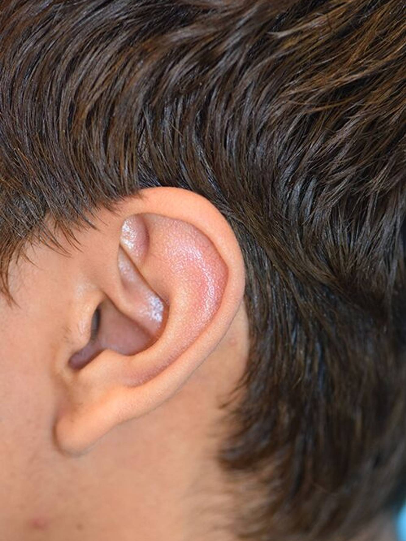 Ear Reshaping Before & After Image