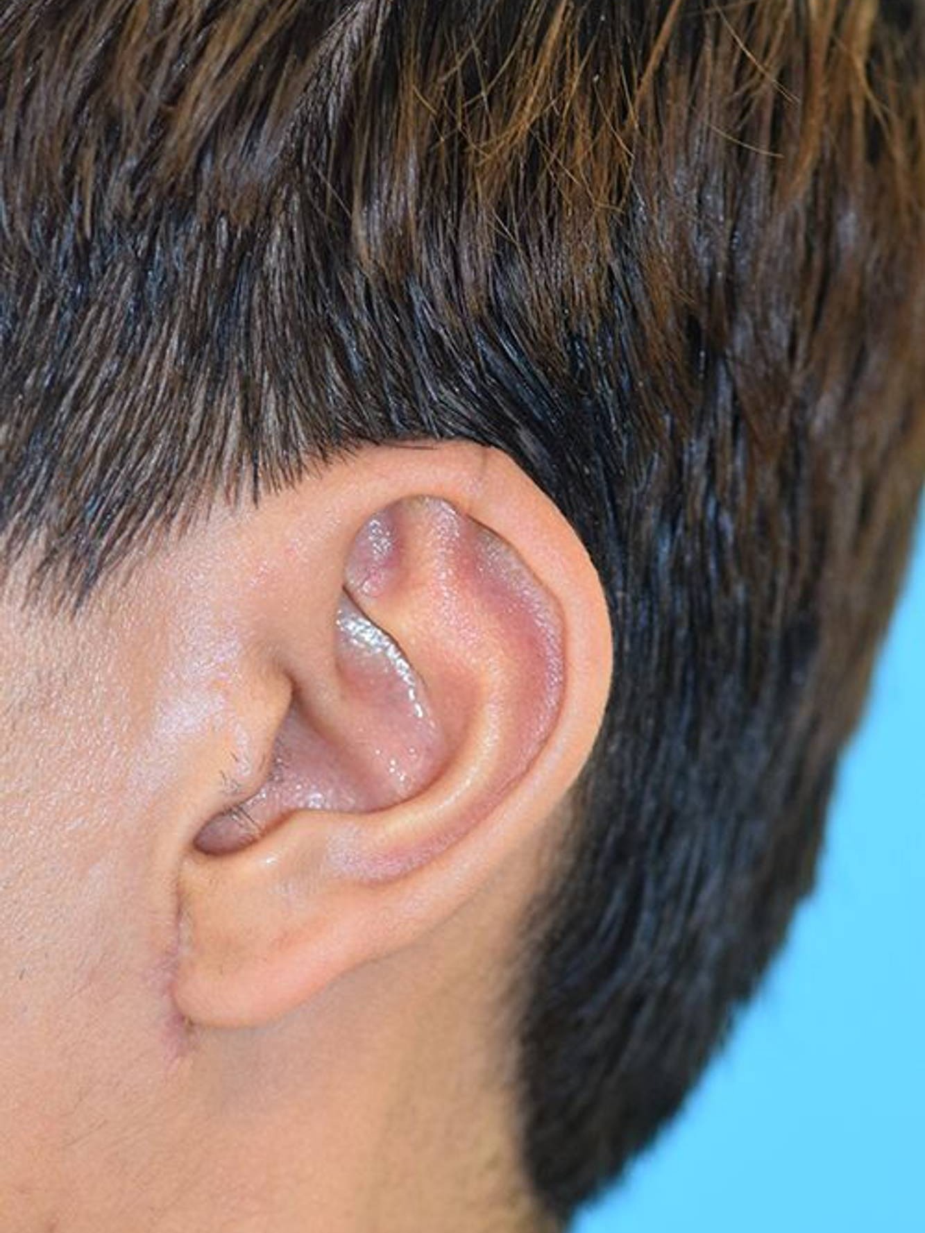 Ear Reshaping Before & After Image