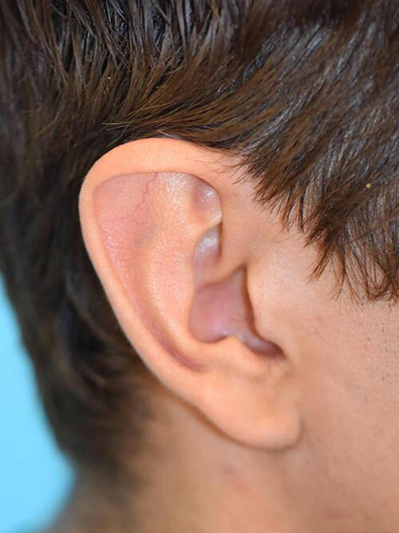 Ear Reshaping Before & After Image