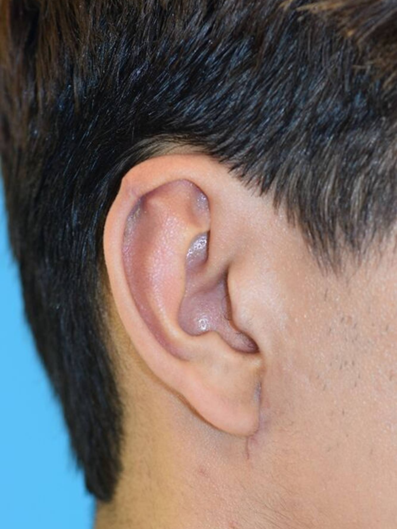 Ear Reshaping Before & After Image