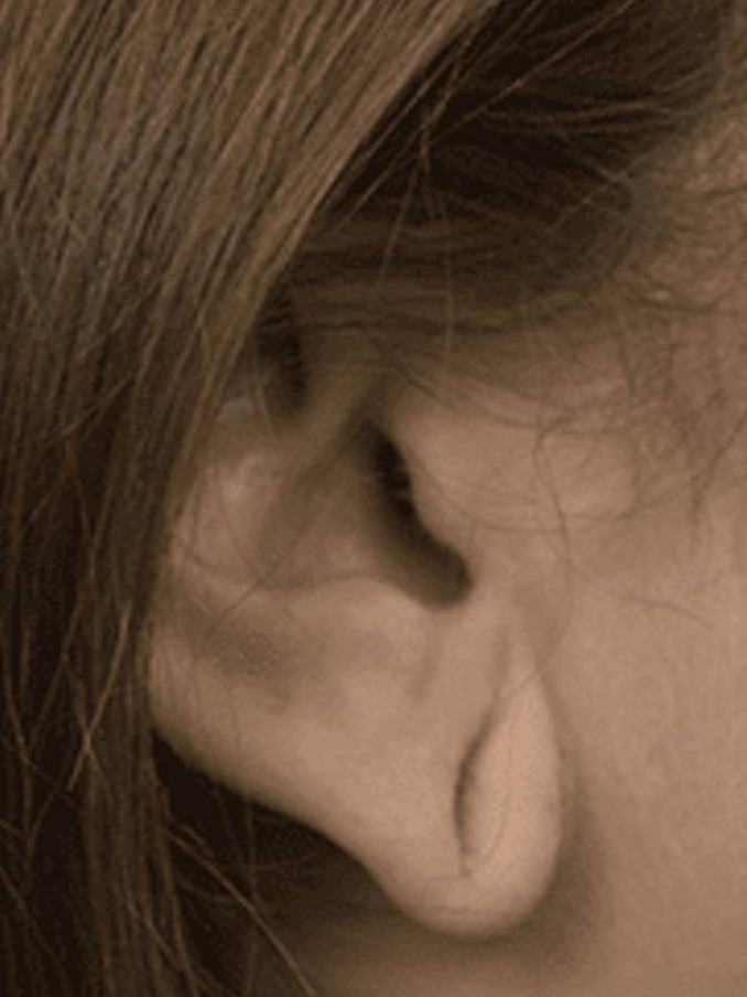 Earlobe Repair Before & After Image