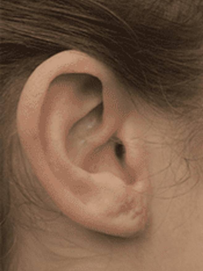 Earlobe Repair Before & After Image