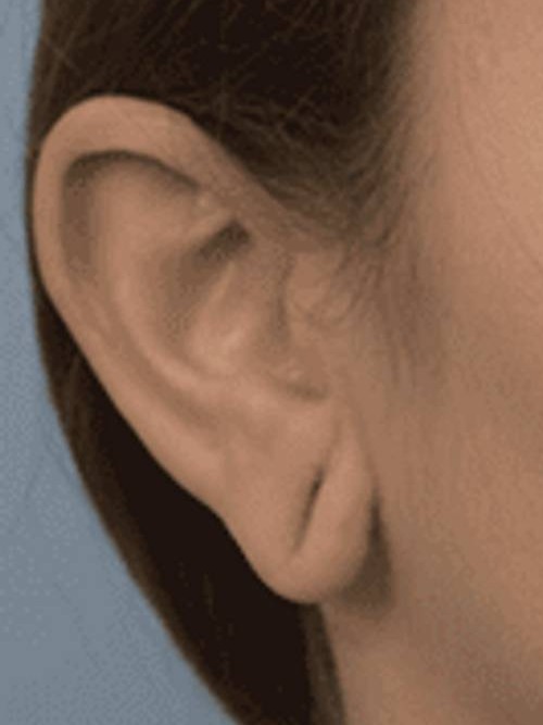 Earlobe Repair Before & After Image