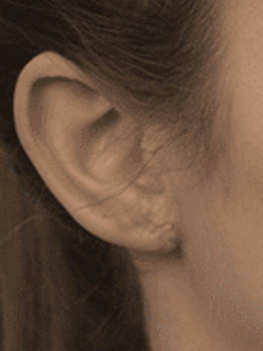 Earlobe Repair Before & After Image