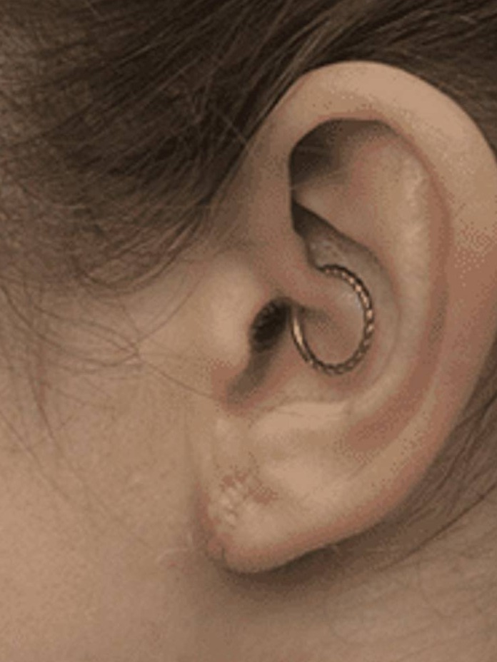 Earlobe Repair Before & After Image