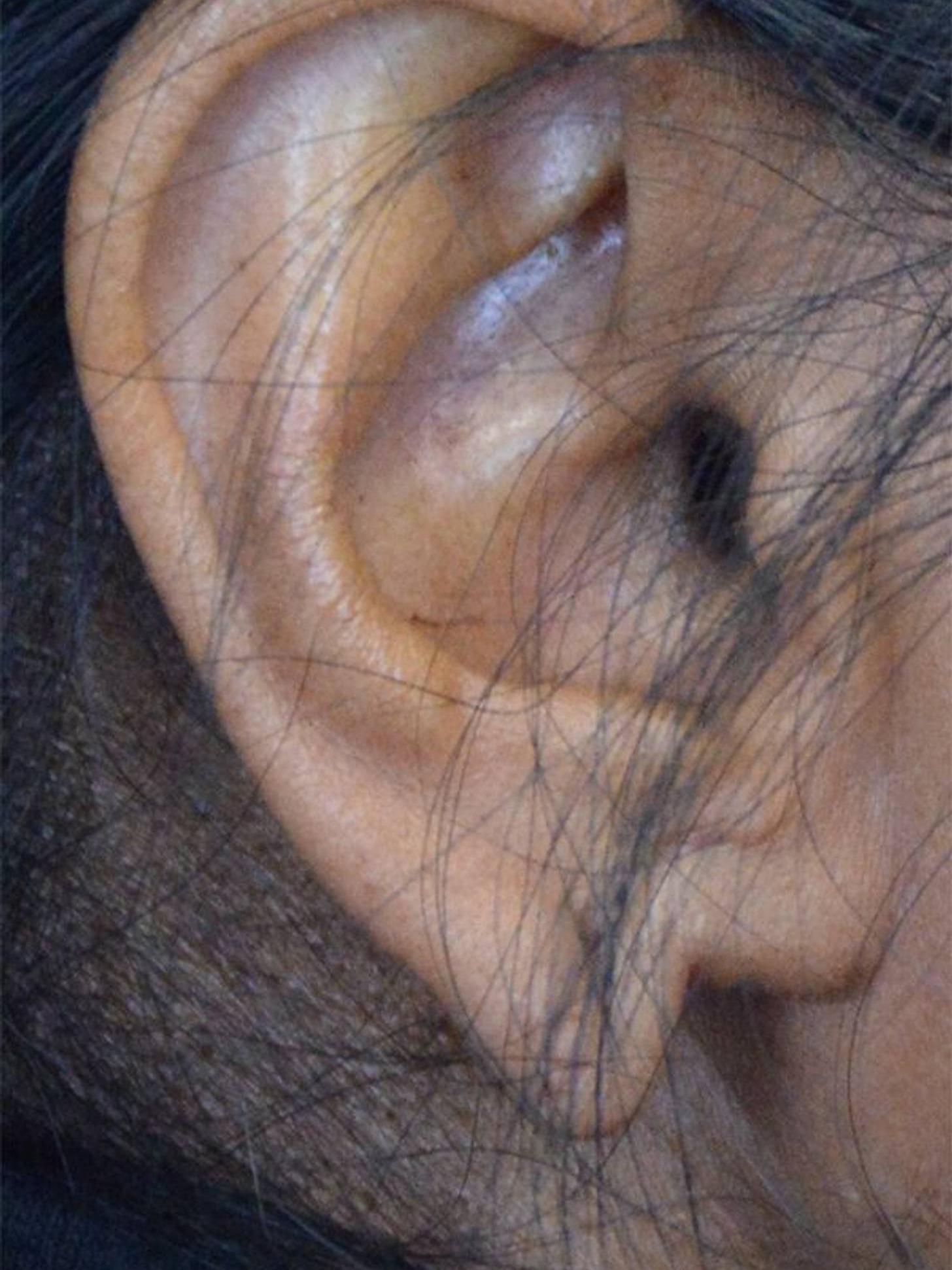 Earlobe Repair Before & After Image