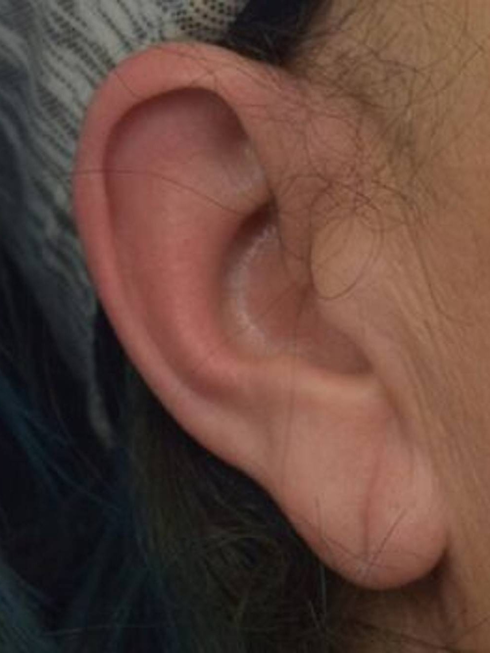 Earlobe Repair Before & After Image