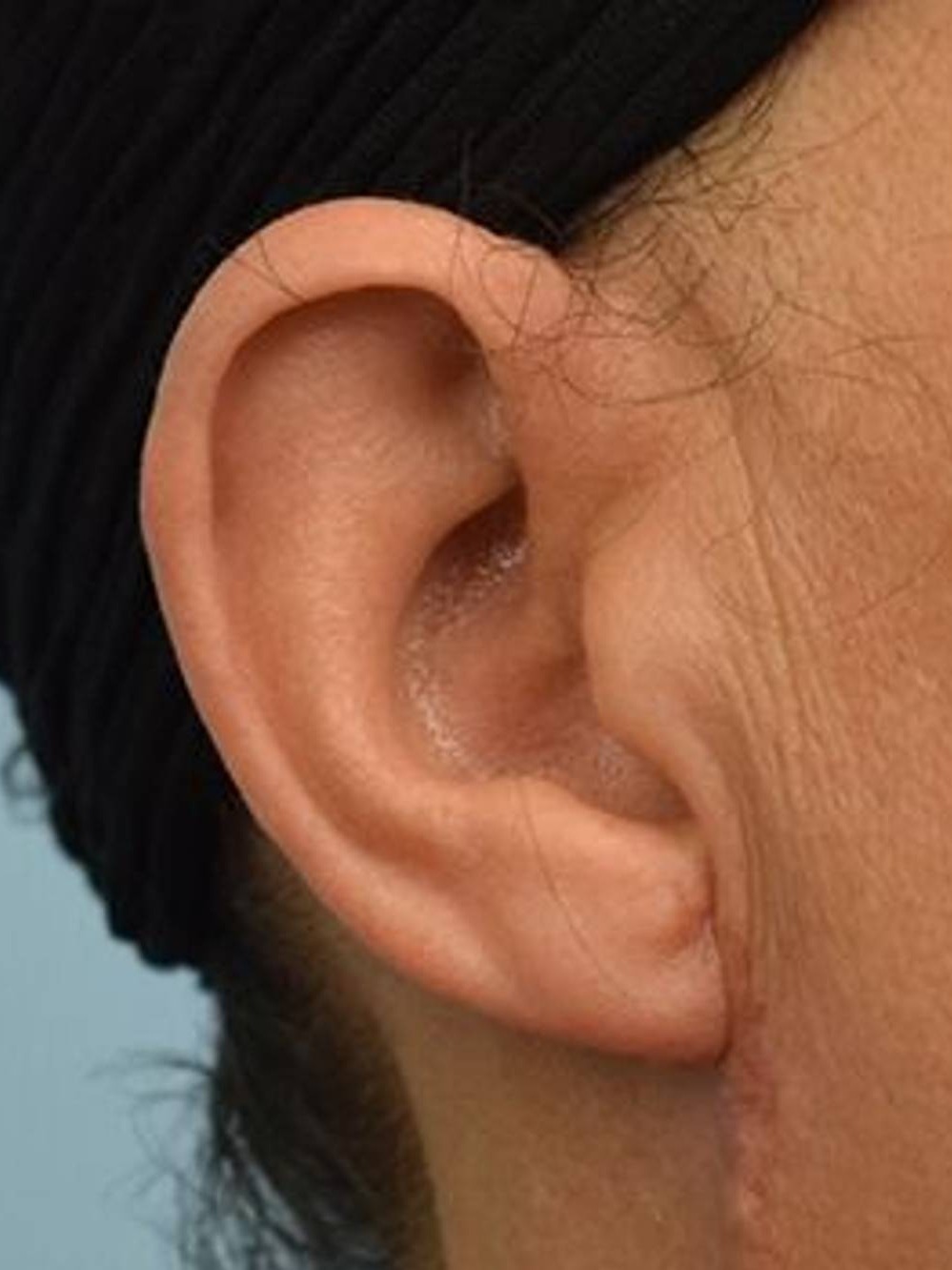 Earlobe Repair Before & After Image