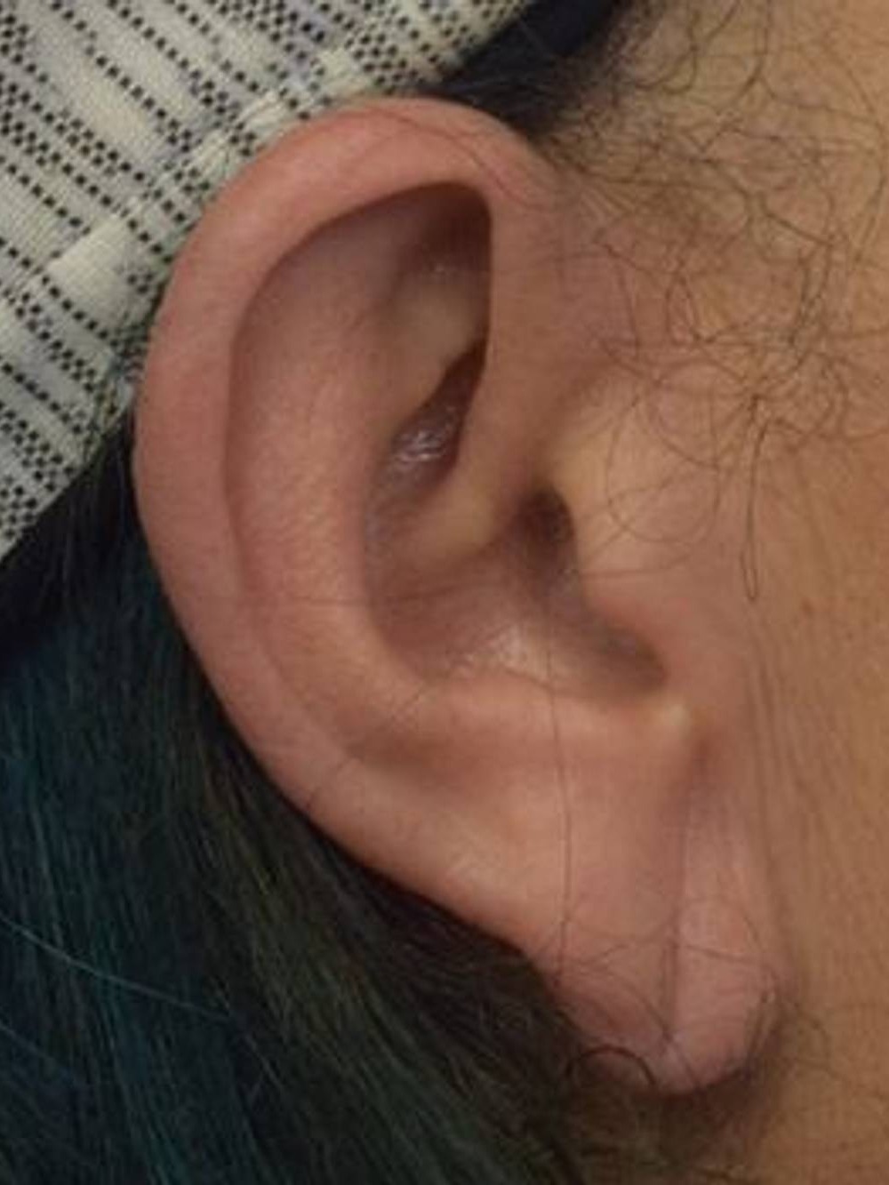 Earlobe Repair Before & After Image