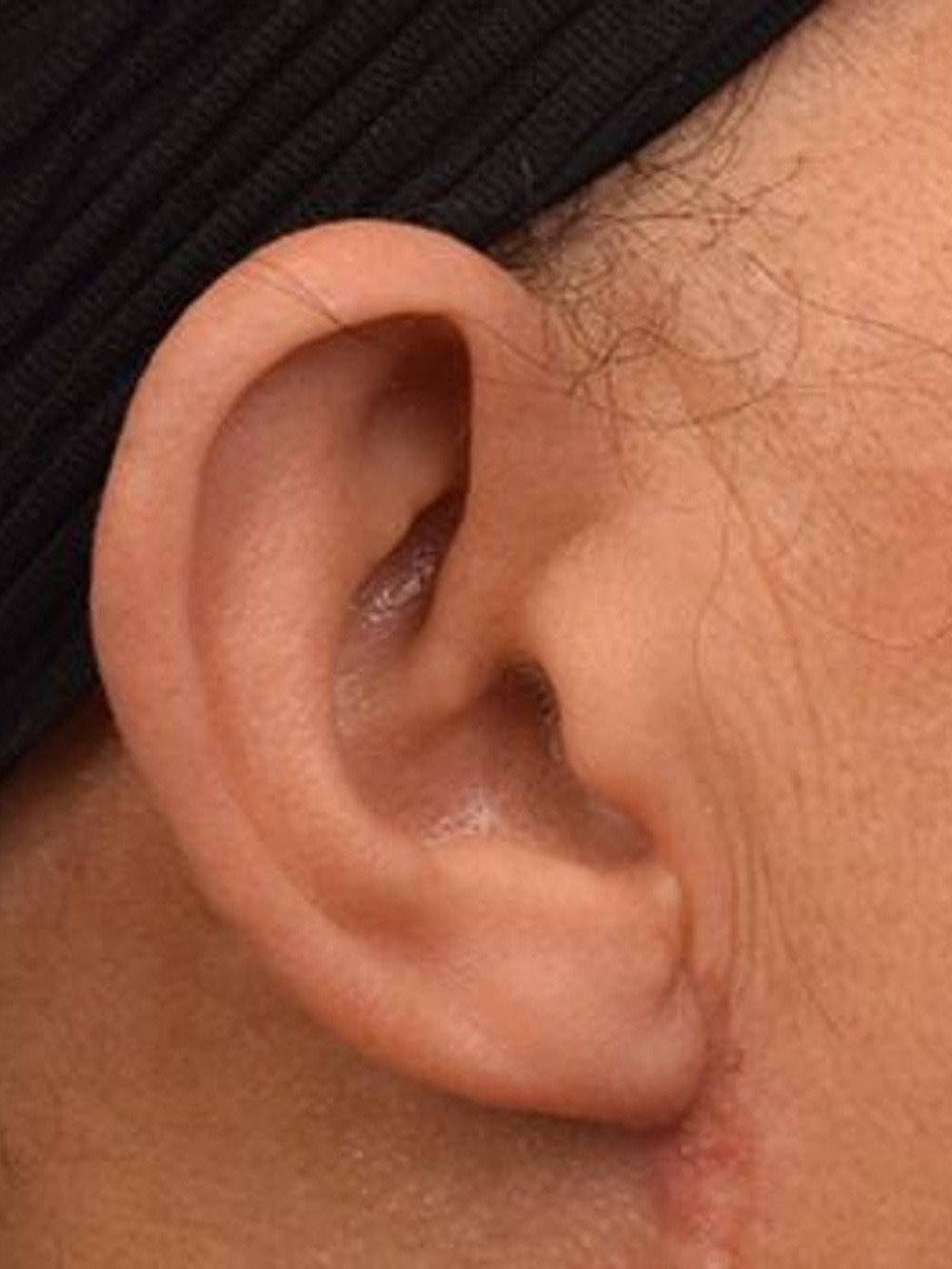 Earlobe Repair Before & After Image