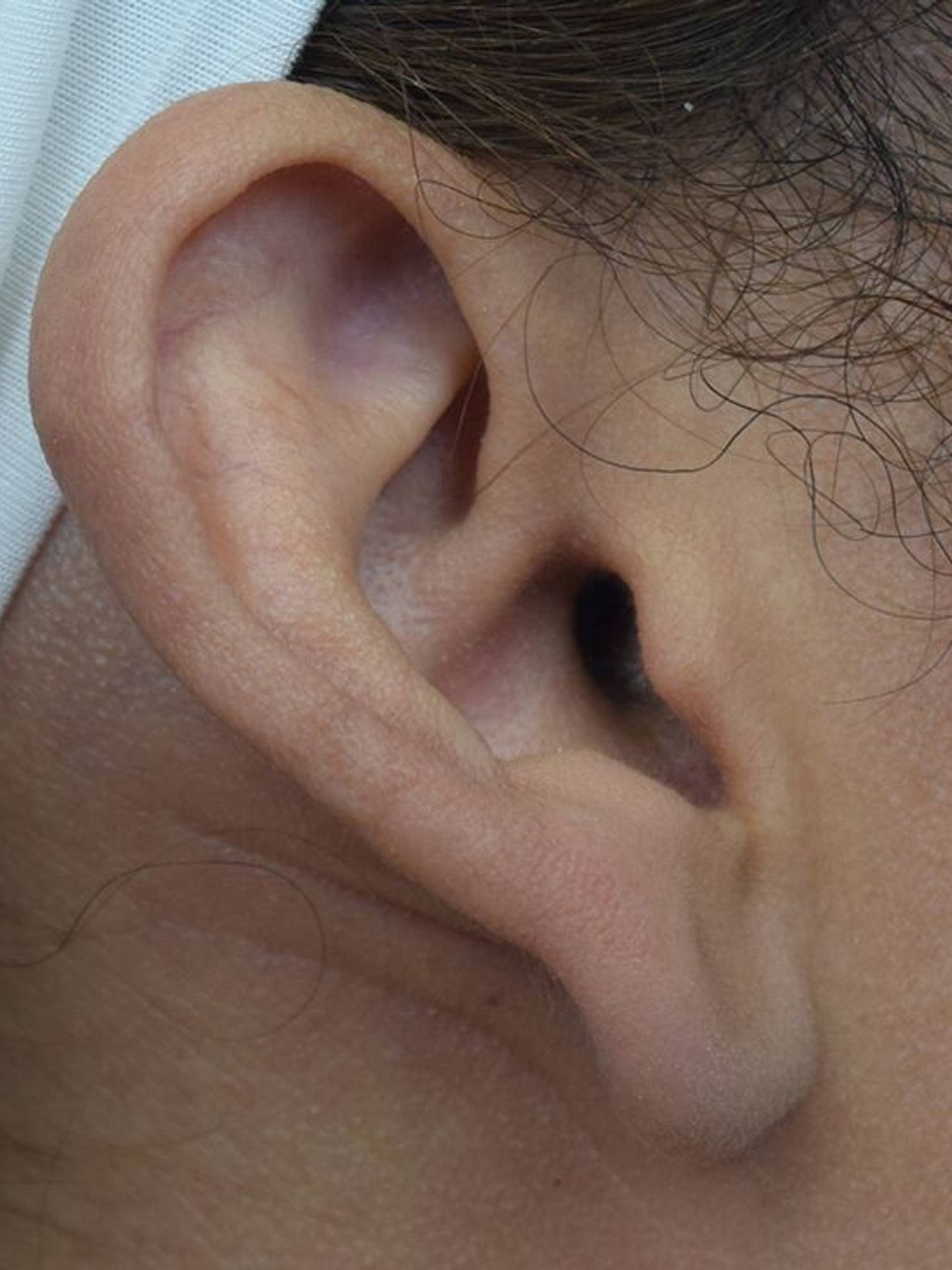 Earlobe Repair Before & After Image