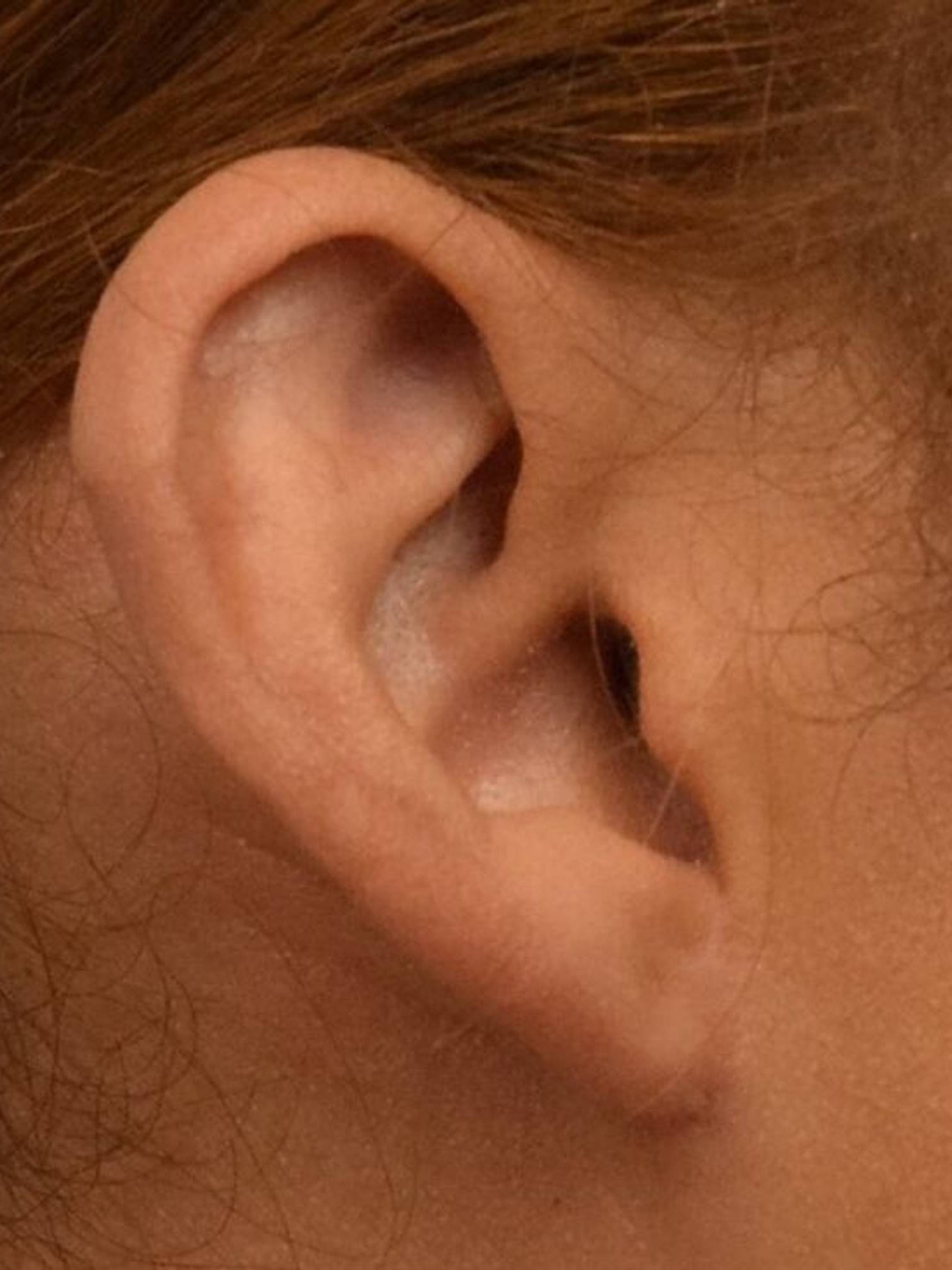 Earlobe Repair Before & After Image