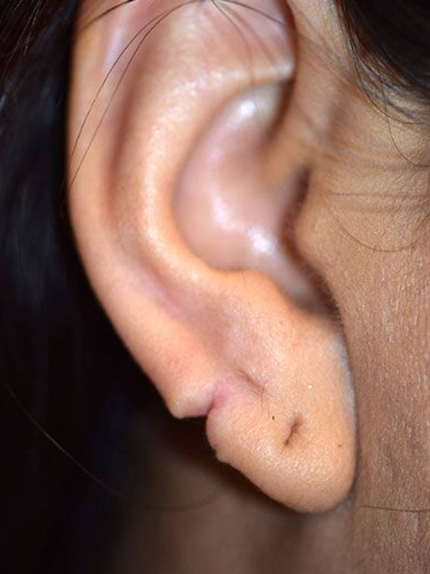 Earlobe Repair Before & After Image