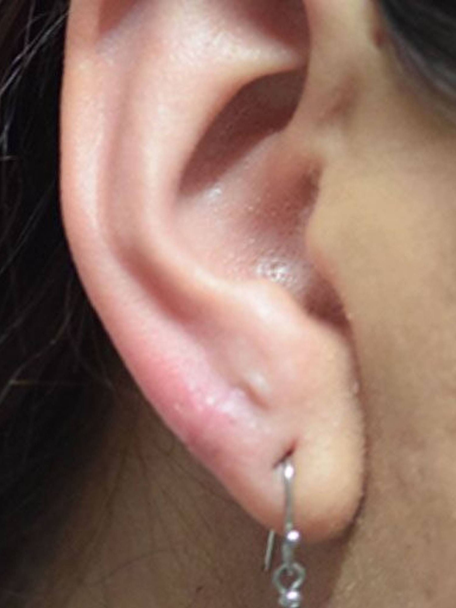 Earlobe Repair Before & After Image