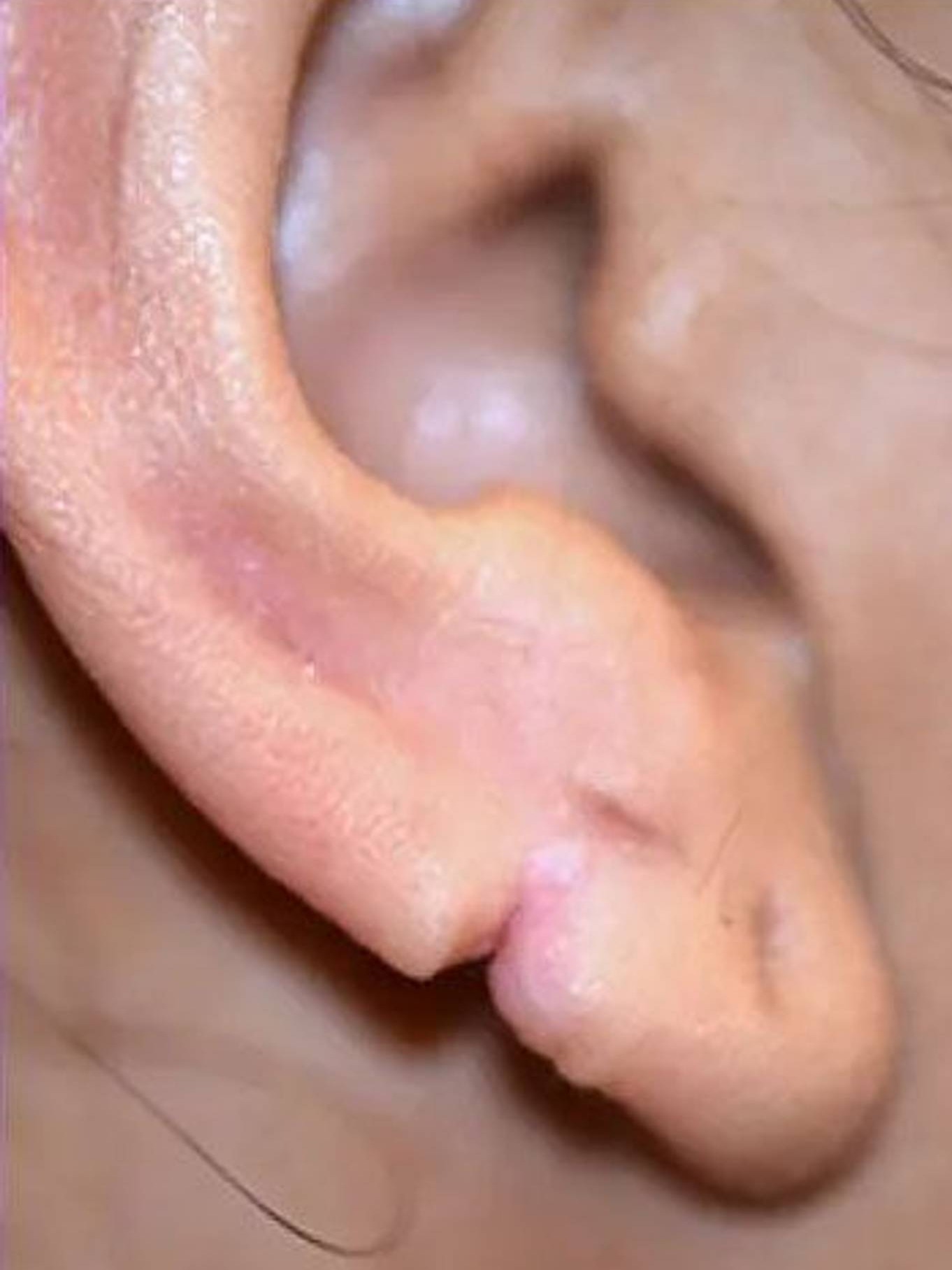 Earlobe Repair Before & After Image