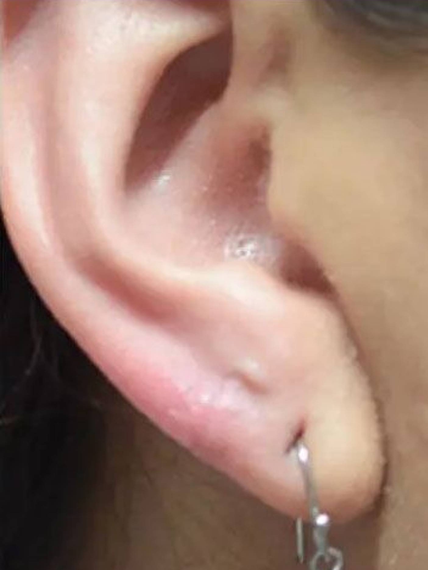 Earlobe Repair Before & After Image