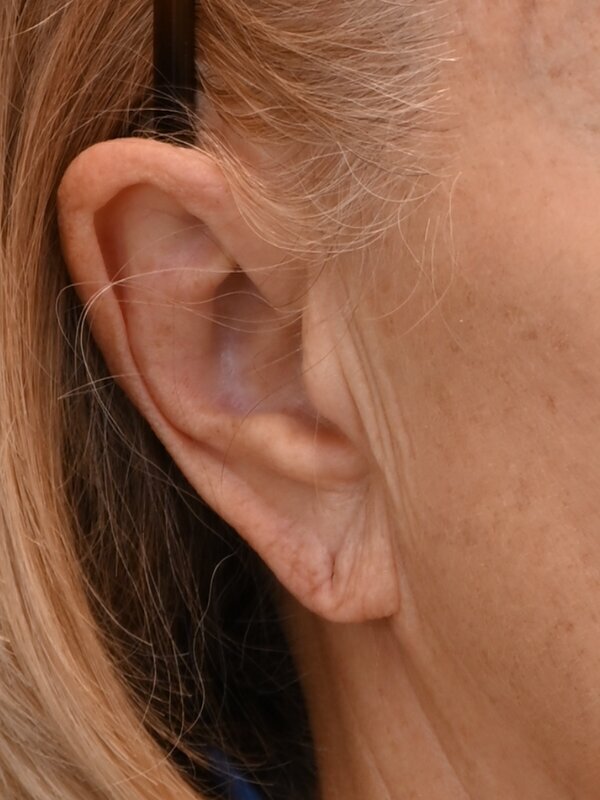 Earlobe Repair Before & After Image