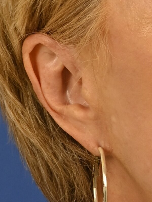 Earlobe Repair Before & After Image