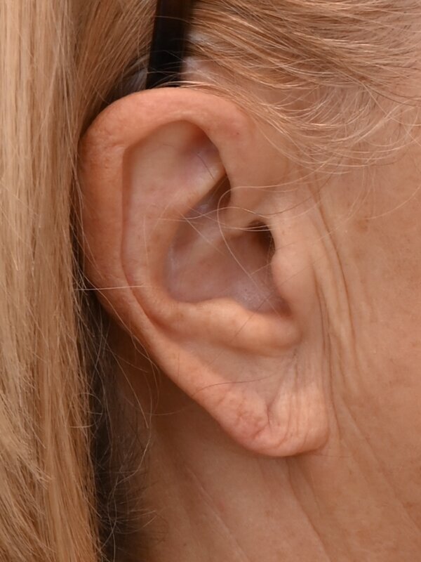 Earlobe Repair Before & After Image
