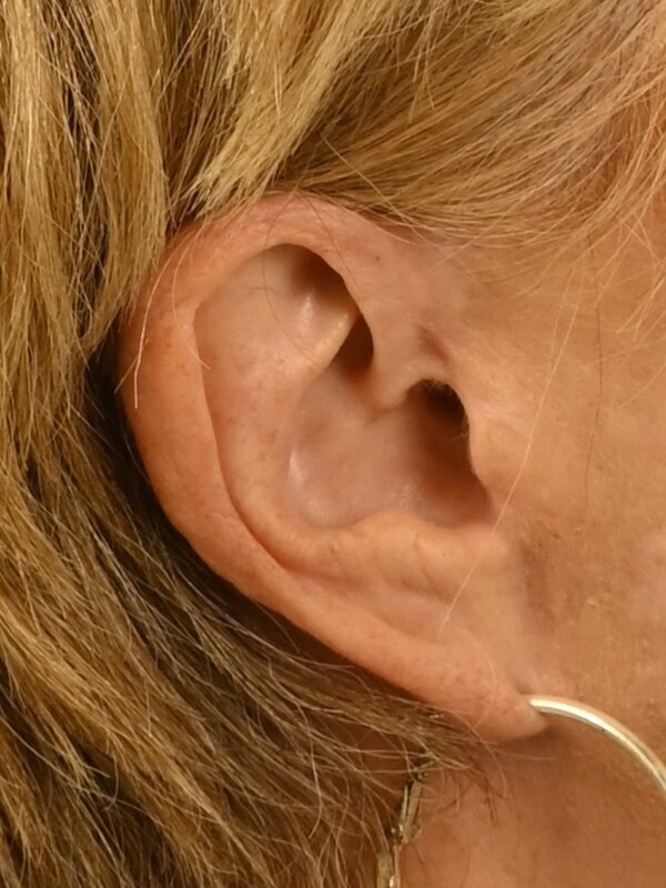 Earlobe Repair Before & After Image
